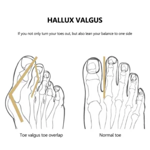 Adjustable Bunion Toe Corrector